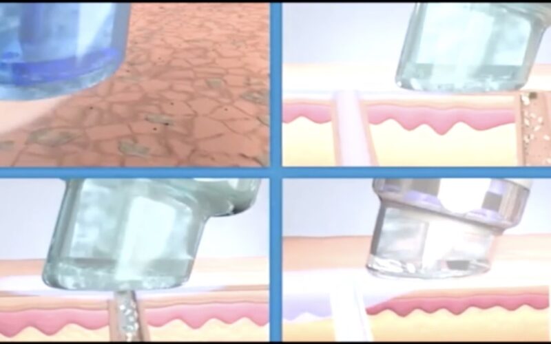 ハイドラ式洗浄フェイシャルでよみがえるゆでたまご肌【肌#02】