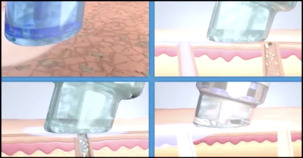 ハイドラ式洗浄フェイシャルでよみがえるゆでたまご肌【肌#02】